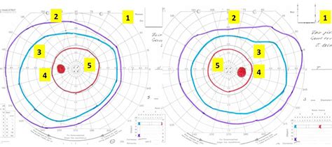 How to interpret visual fields .